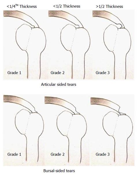 8 mm tear test|Rotator Cuff Tears .